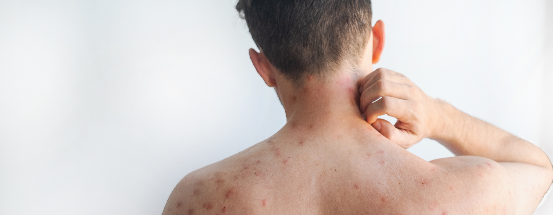 Sarampo: tudo o que você precisa saber