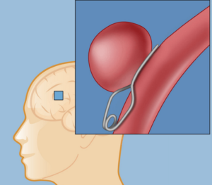 imagem descritiva do aneurisma cerebral