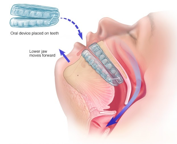 apneia-do-sono-aparelho-dental+