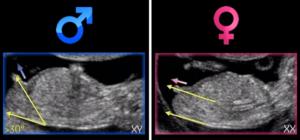 sexagem-fetal