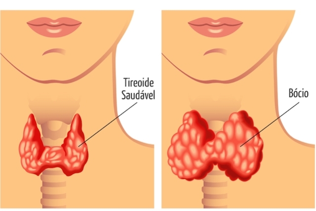 bocio-o-que-e-e-quais-os-sintomas