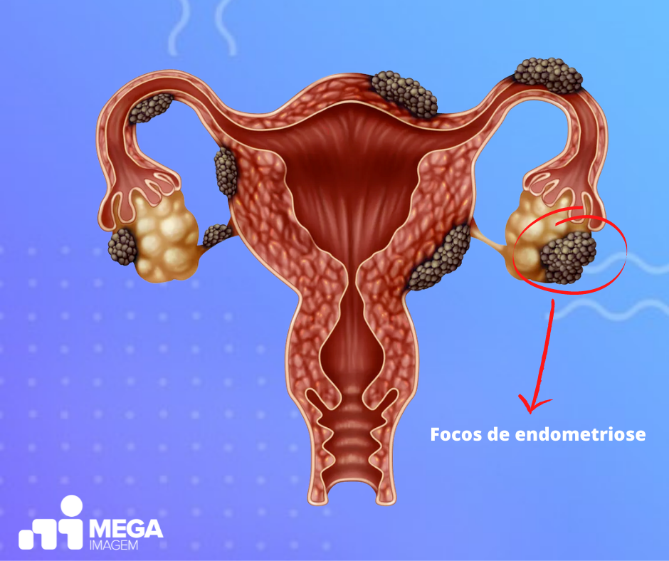 endometriose-focos
