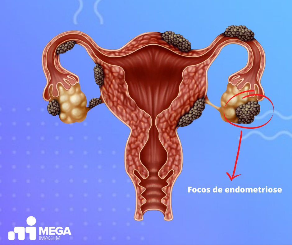 O que é endometrioma?