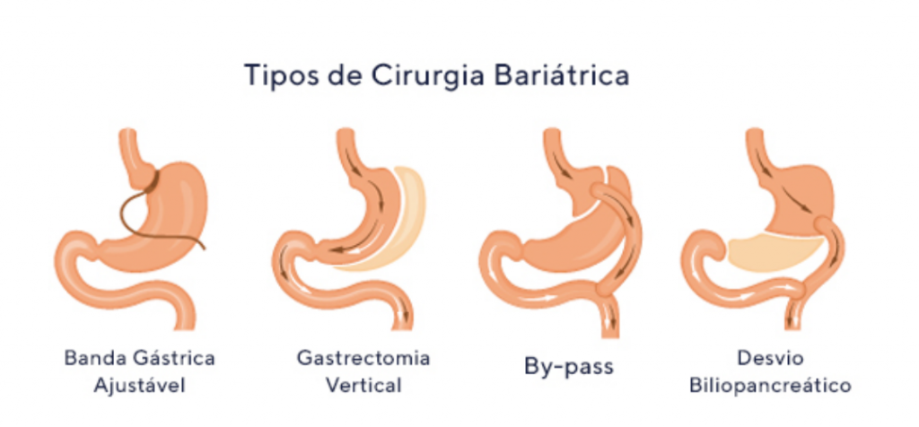 cirurgia-bariatrica