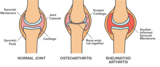 Artrite Reumatoide 