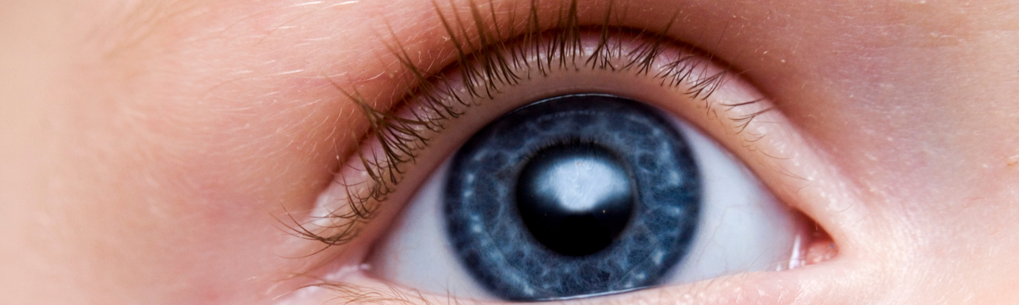 O que é retinoblastoma e como diagnosticar?