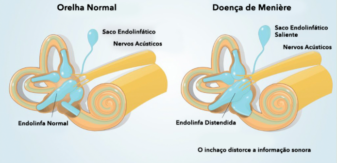 sindrome-de-meniere