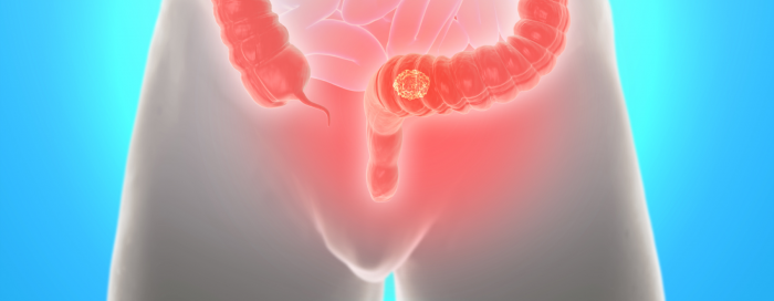 Câncer de reto: sintomas, causas e tratamentos