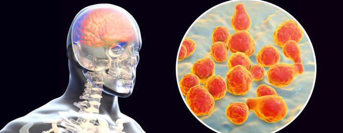 Meningite: o que é, sintomas e prevenção