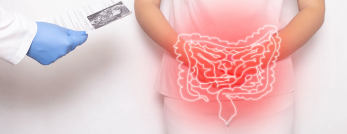 Câncer de intestino: sintomas e prevenção