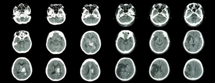 acidente-vascular-cerebral