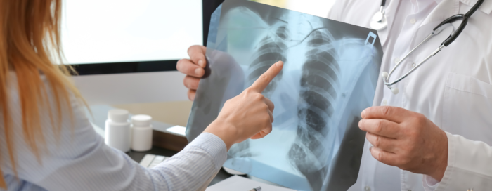 Edema pulmonar: causas, sintomas e tratamentos