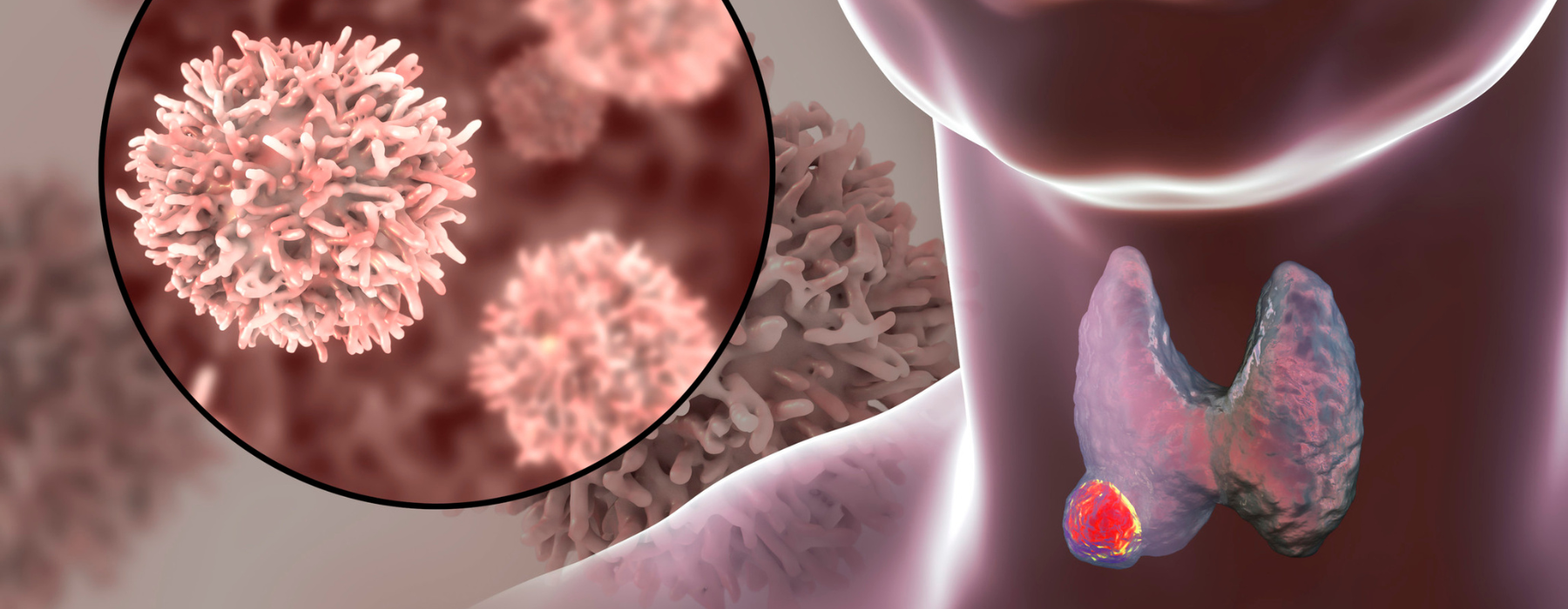  Ilustração médica mostrando tumor na tireoide e células tumorais, ressaltando o uso de ressonância ou tomografia no diagnóstico.