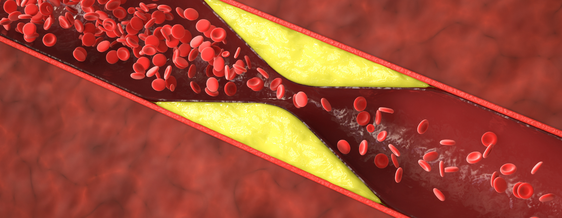 Vaso sanguíneo parcialmente bloqueado por gordura e coágulos, mostrando o risco de obstrução e trombose.