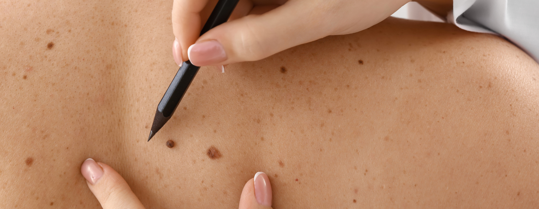 Câncer de pele: como é feito o diagnóstico?