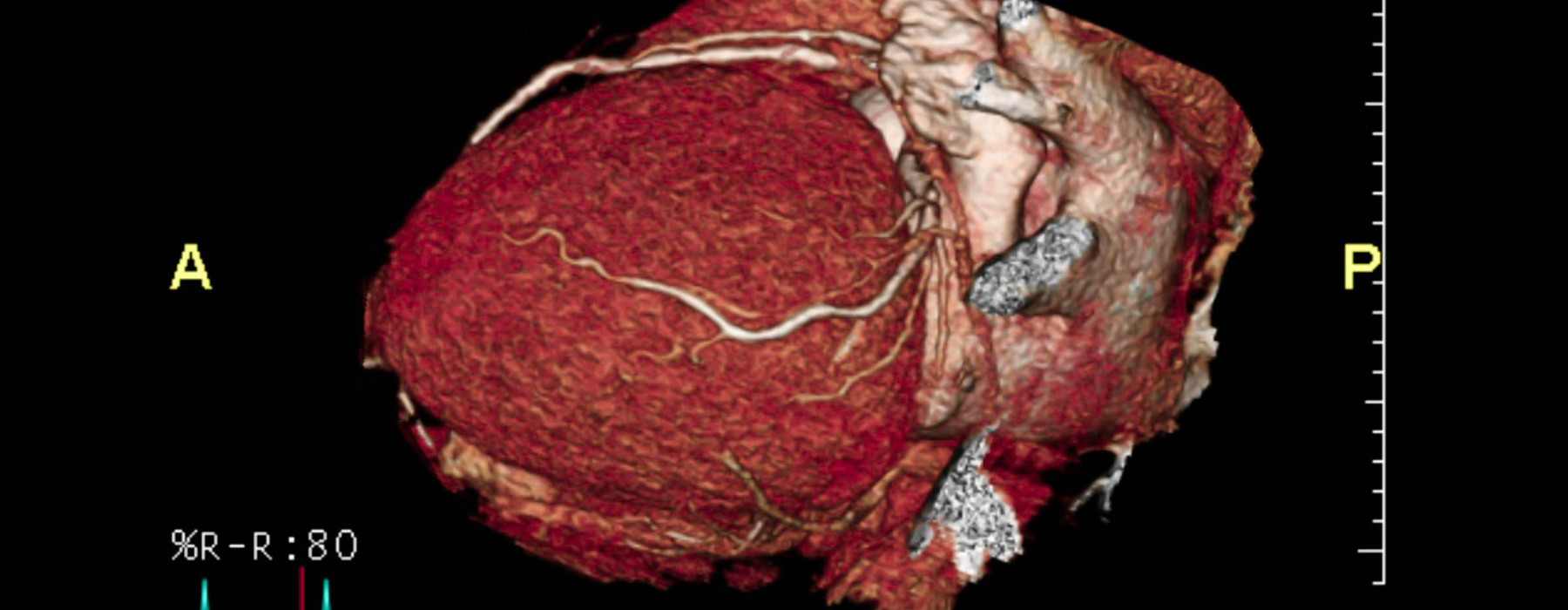 Exames de imagem na prevenção do AVC: quem deve investigar e quais exames são indicados