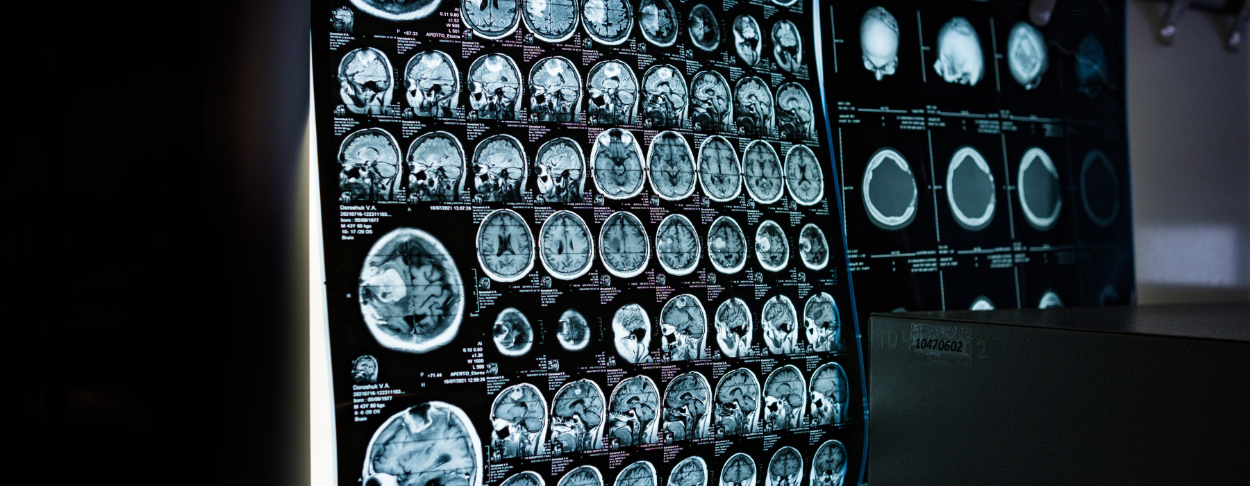 Painel com imagens de ressonância magnética cerebral mostrando diferentes cortes do cérebro para investigação de dor de cabeça e tontura.