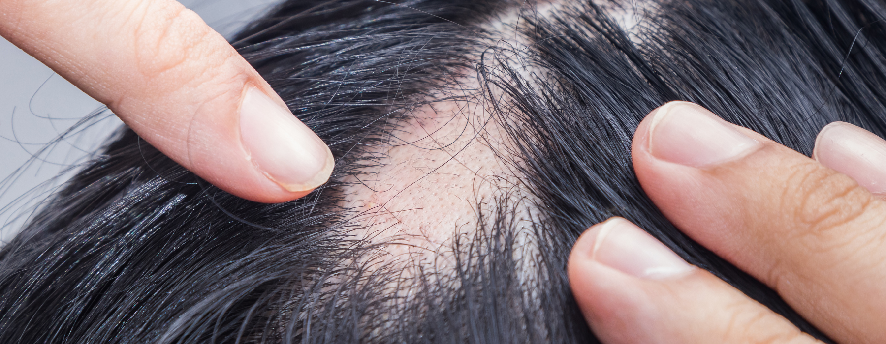 Alopecia areata: o que causa a doença autoimune?