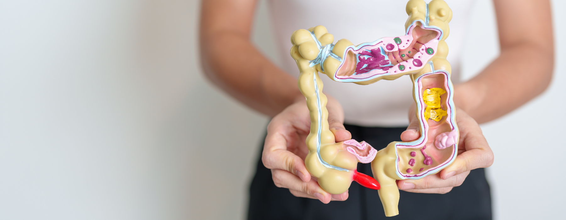 Modelo de intestino com inflamações que representam a diverticulite.