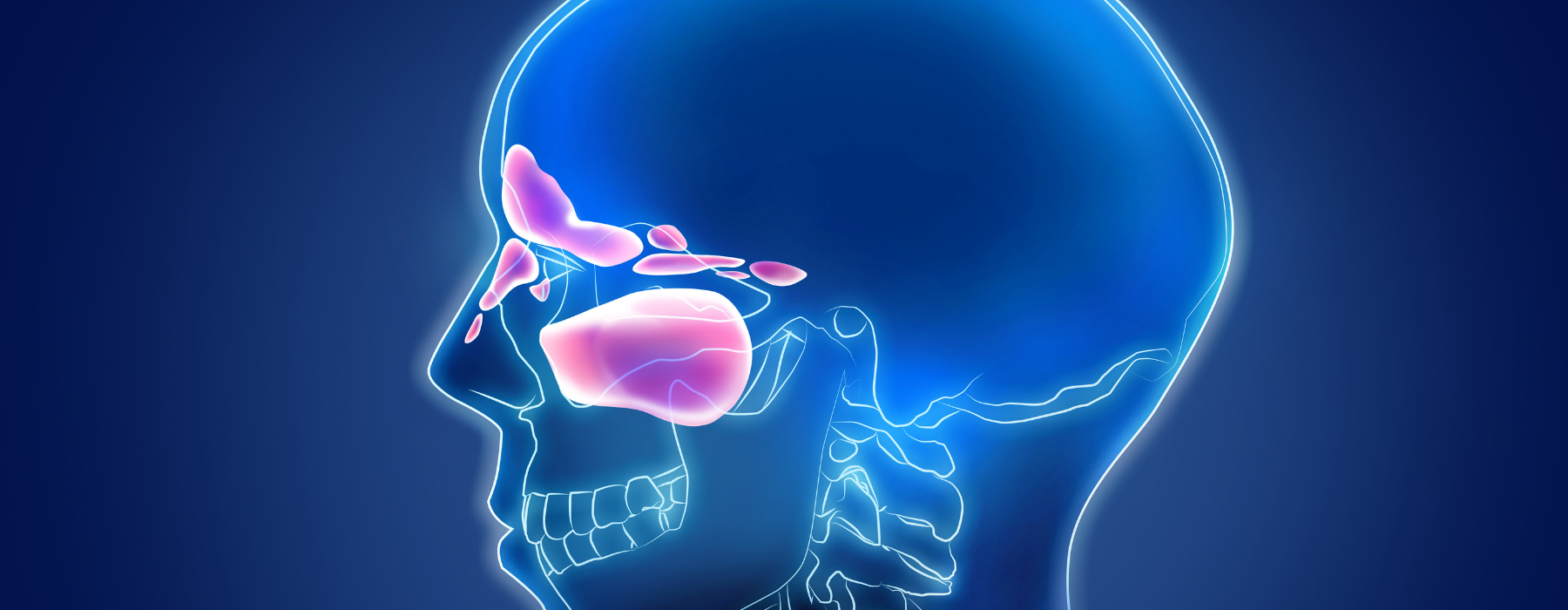 Ilustração médica do crânio humano destacando os seios da face inflamados, representando regiões afetadas pela sinusite.