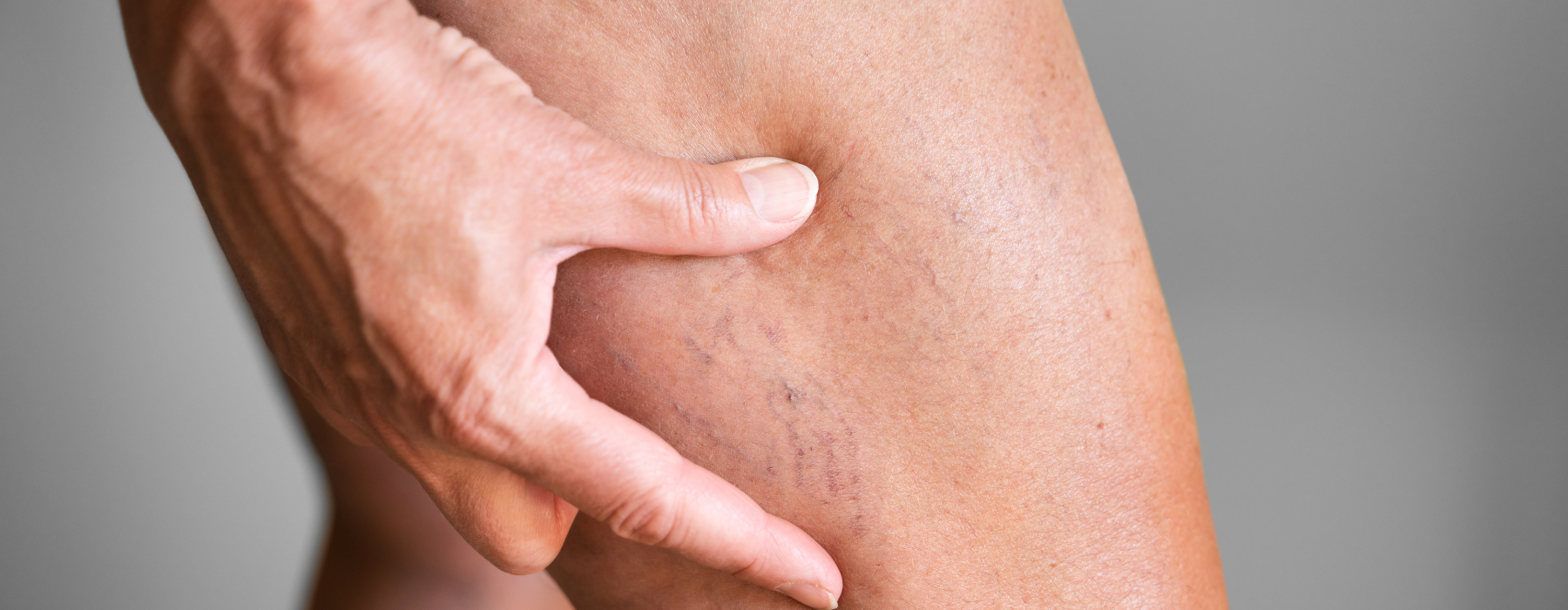 Mounjaro e lipedema: caneta pode ajudar no tratamento?