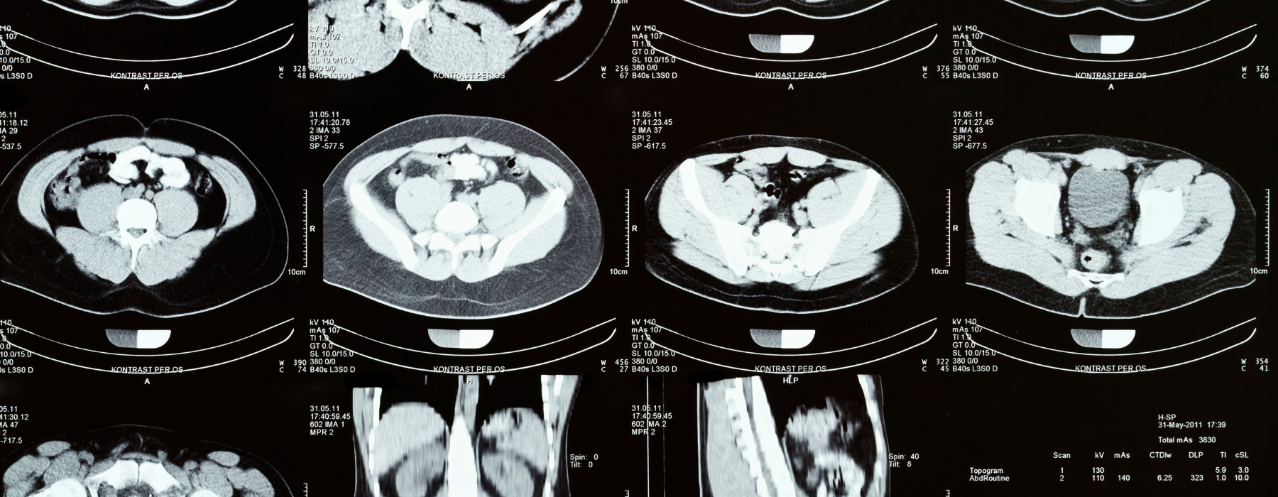 Imagens médicas de tomografia computadorizada exibindo cortes internos do abdômen e pelve.