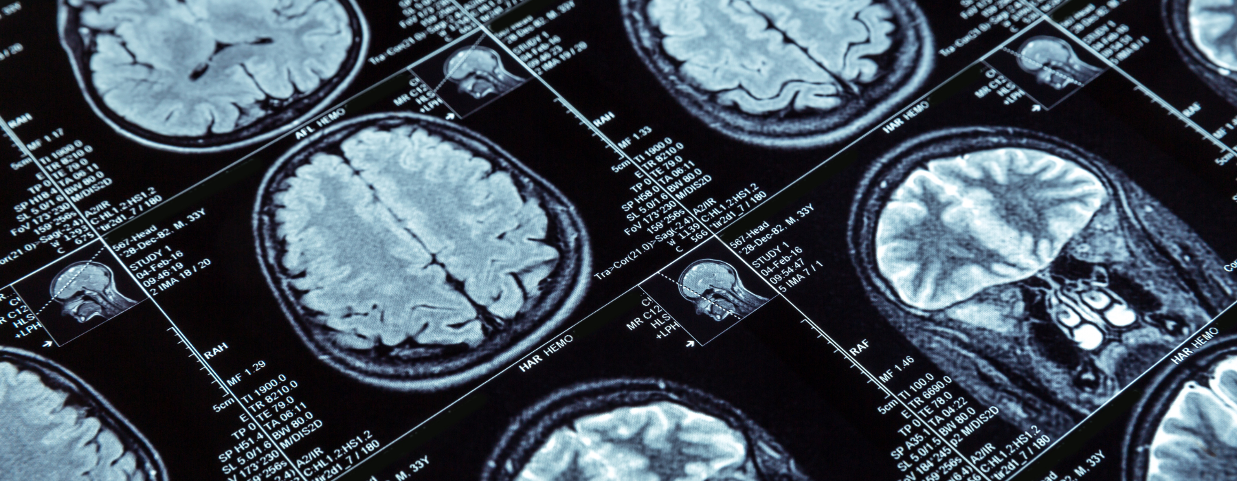Imagens de ressonância magnética cerebral exibidas em sequência para análise médica e diagnóstico por imagem.