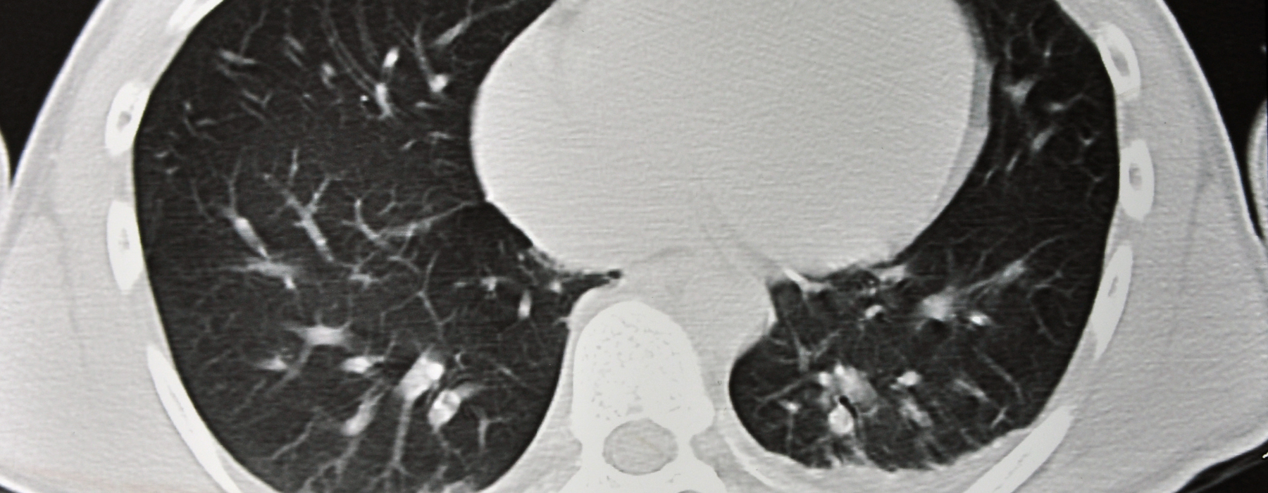 Tomografia computadorizada do tórax mostrando alterações que ajudam a identificar o que a tomografia pode mostrar na fibrose pulmonar.